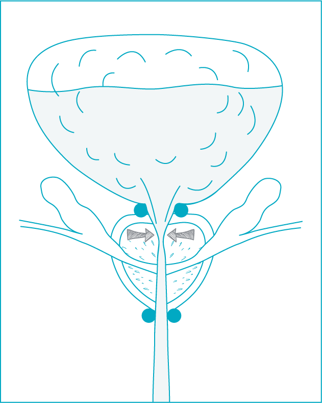 schema-incontinence-adenome-01