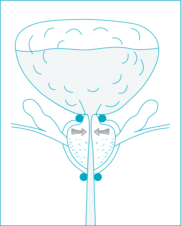 schema-incontinence-adenome-02