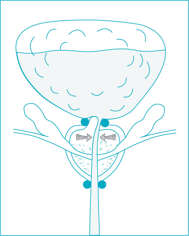 schema-incontinence-adenome-03