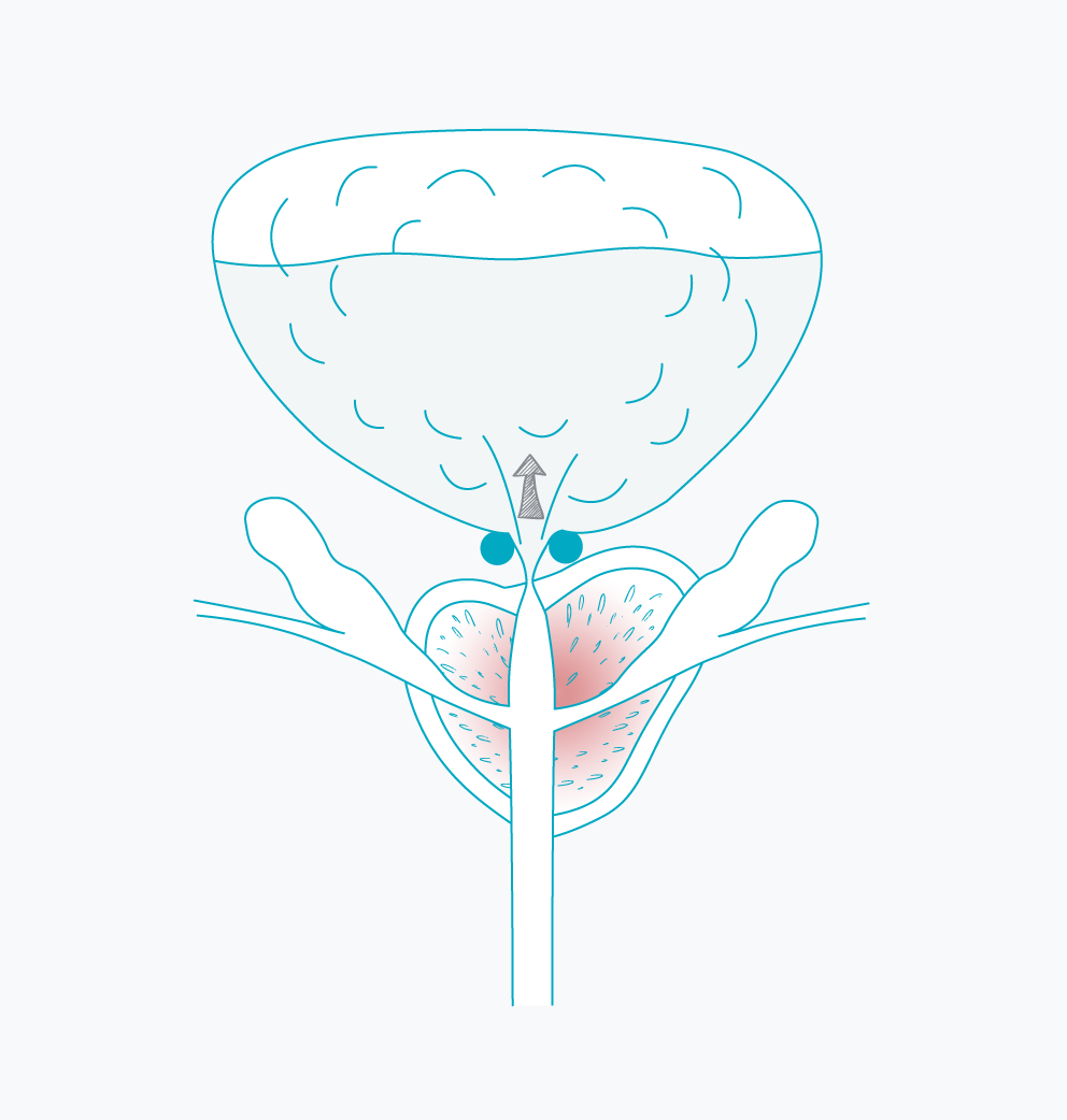 schéma d'une prostate avec hypertrophie