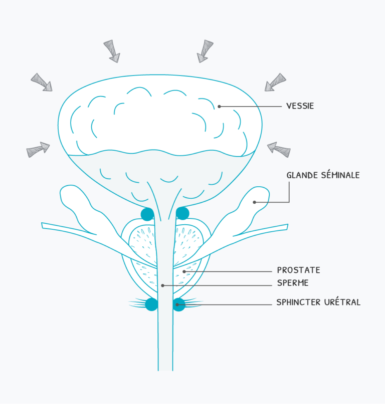 Fuites urinaires, sphincters et périnée Incontinence Homme — free download